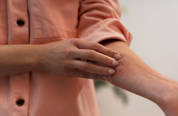 el brazo de un hombre con síntomas de la dermatitis seborreica