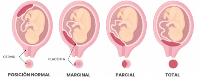tipos de placenta previa